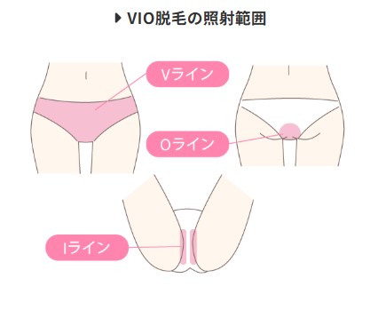 VIOのイメージ写真